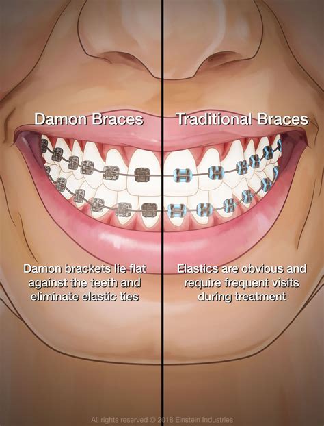 damon brackets vs metal braces|damon braces pros and cons.